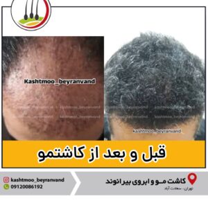 مراقبت های قبل و بعد از کاشت مو در کلینیک تخصصی پوست و مو بیرانوند