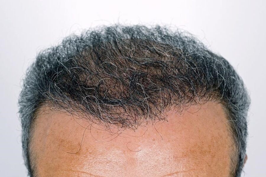 مراقبت های قبل و بعد از کاشت مو