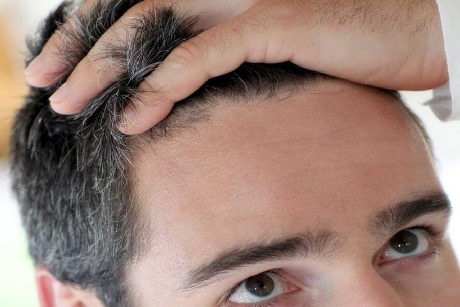 فاکتورهای موثر بر کاشت مو