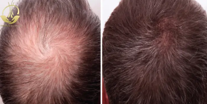 تفاوت کاشت مو به روش HRT با دیگر روش ها
