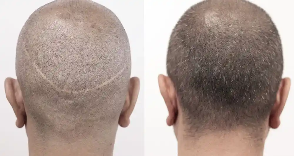 تفاوت کاشت مو به روش FUT